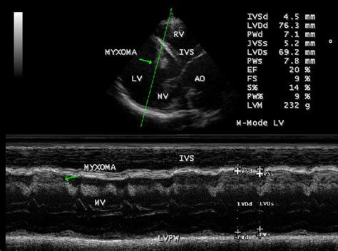 lv hypokinesia|severe hypokinesis of the apex.